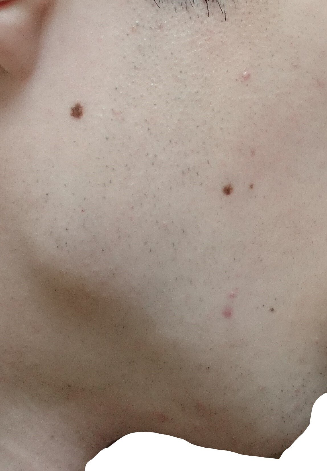 右もみあげ 脱毛２回目２４時間後