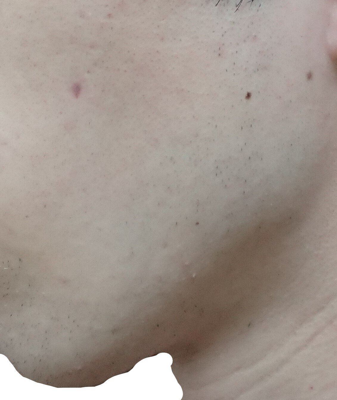 左もみあげ 脱毛２回目２４時間後