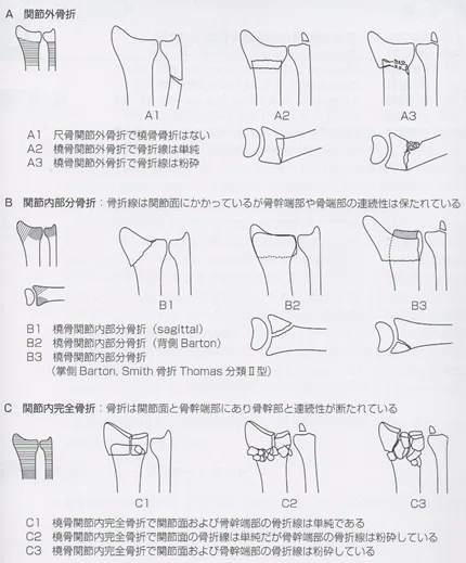 橈骨遠位端骨折を診る上で必要な知識①疫学、分類｜小林 博樹
