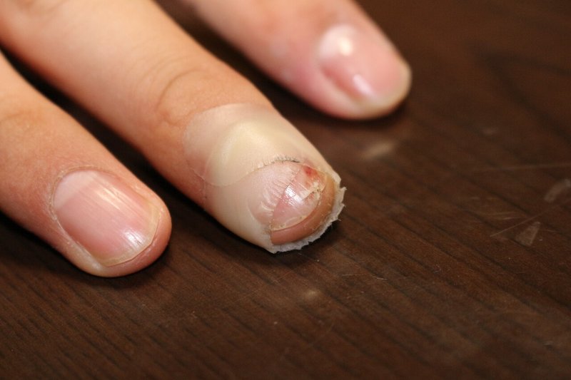 投球による爪のトラブル Nfp Plus Note