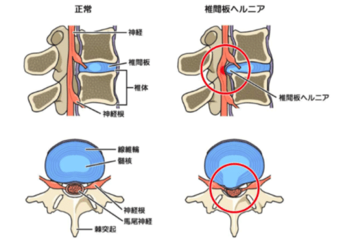 ヘルニア-500x359