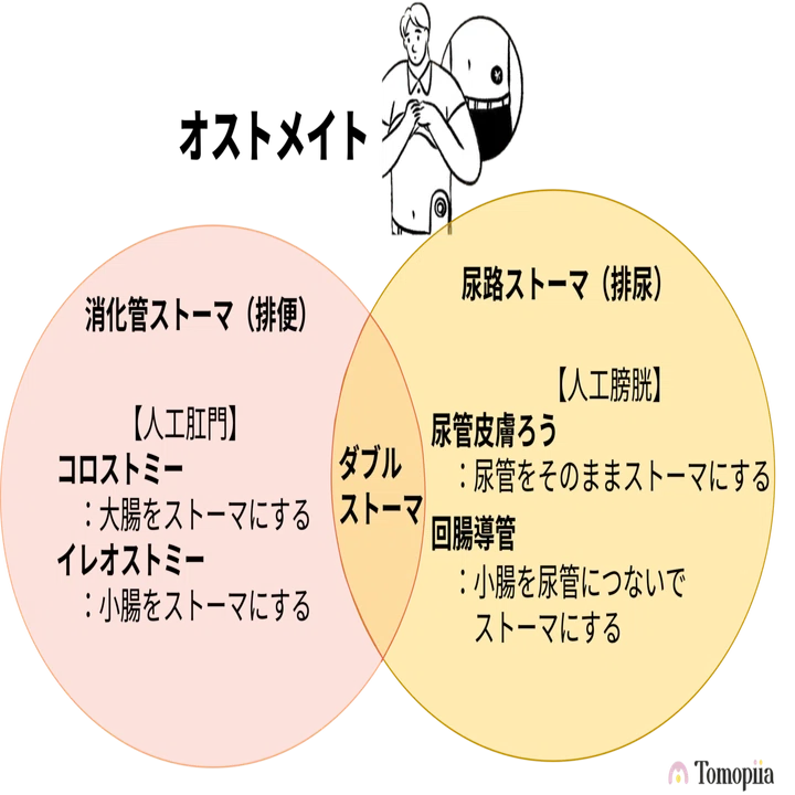 ストマ と は