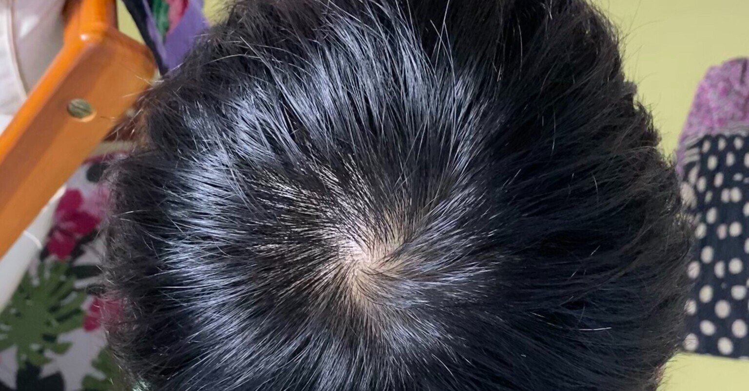 18歳でハゲ 絶望した日 500日後にスキンヘッド Pt学生 Note 18歳でハゲ 絶望した日 500日後にスキンヘッド Pt学生 Note