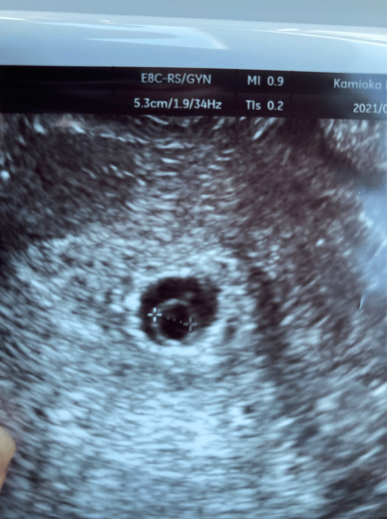 6w2d 心拍確認の日 ゆい Note 6w2d 心拍確認の日 ゆい Note