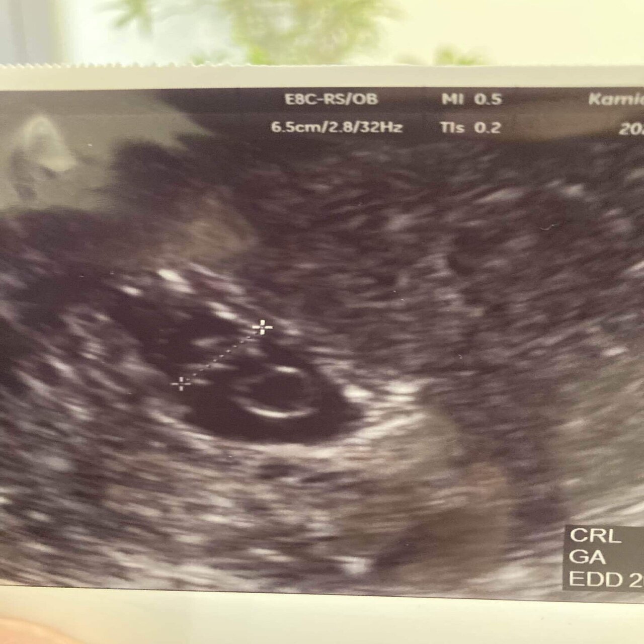 Bt32 7w2d 検診 ゆい Note