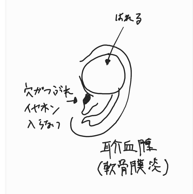 耳の形 ぎょうざ耳