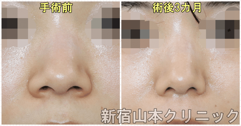 鼻整形失敗 の新着タグ記事一覧 Note つくる つながる とどける 鼻整形失敗 の新着タグ記事一覧 Note つくる つながる とどける