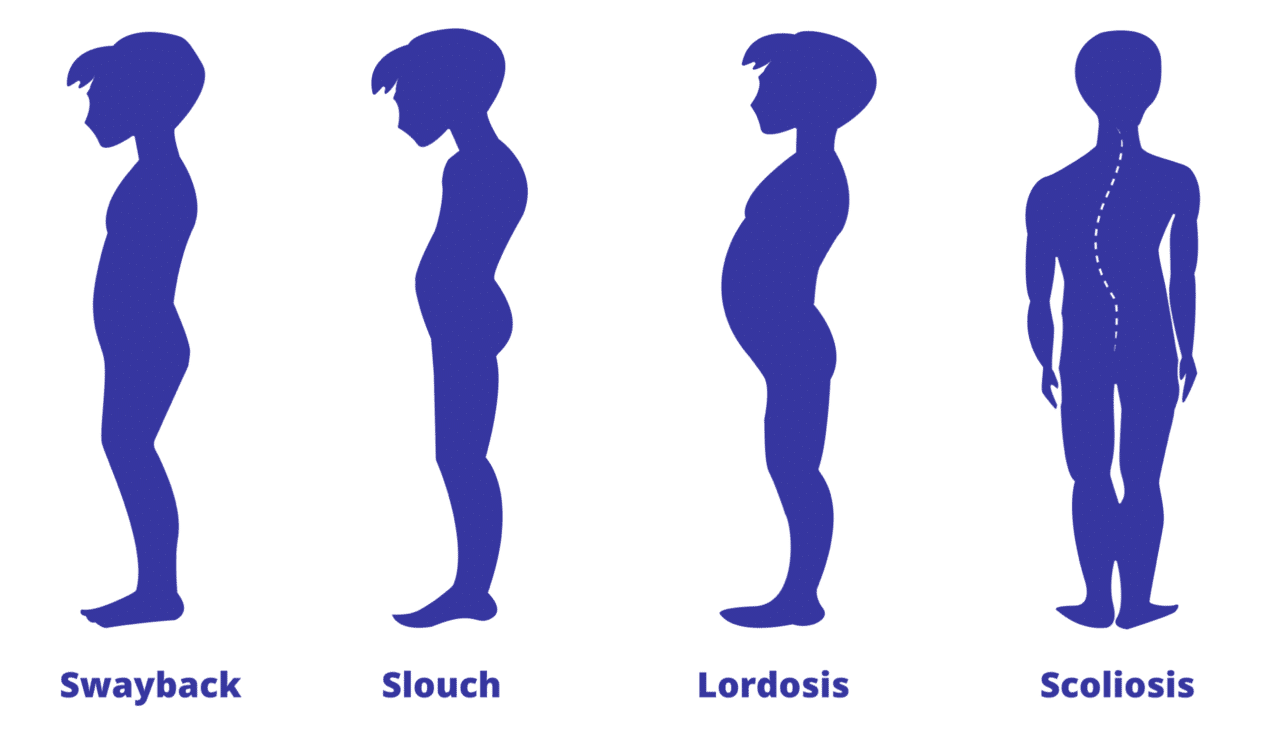 側弯症の機能改善をする考え方 薬師寺偲 理学療法士 ピラティス Note