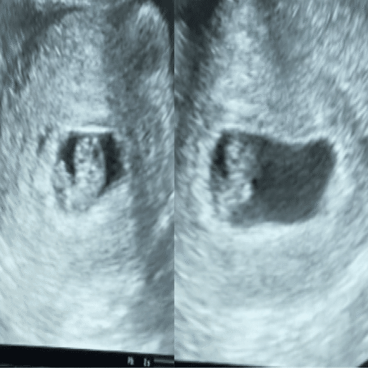 胎嚢の大きさが小さい ゆい Note