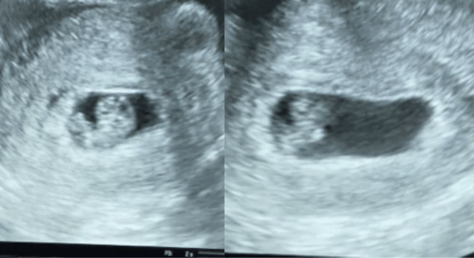 胎嚢の大きさが小さい ゆい Note 胎嚢の大きさが小さい ゆい Note