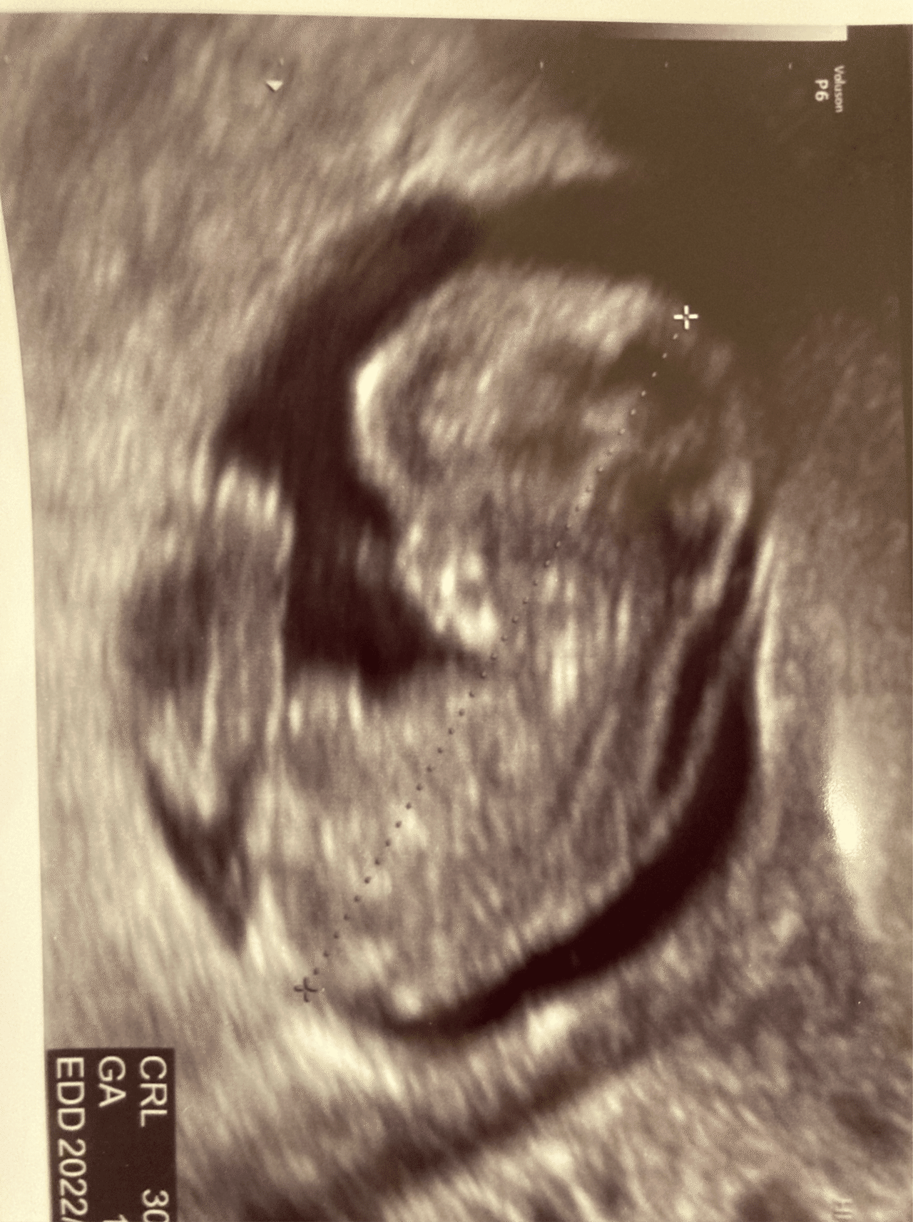 10w3d 流産の心配 ゆい Note