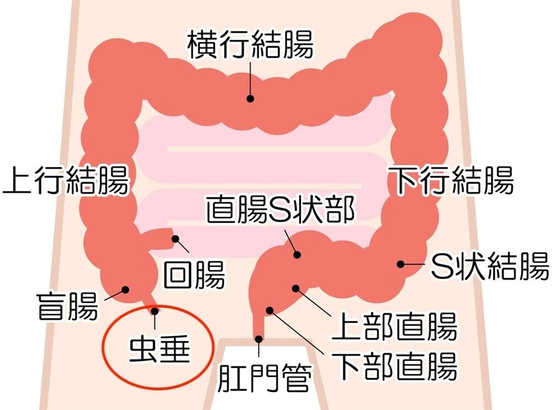 虫垂炎　大腸