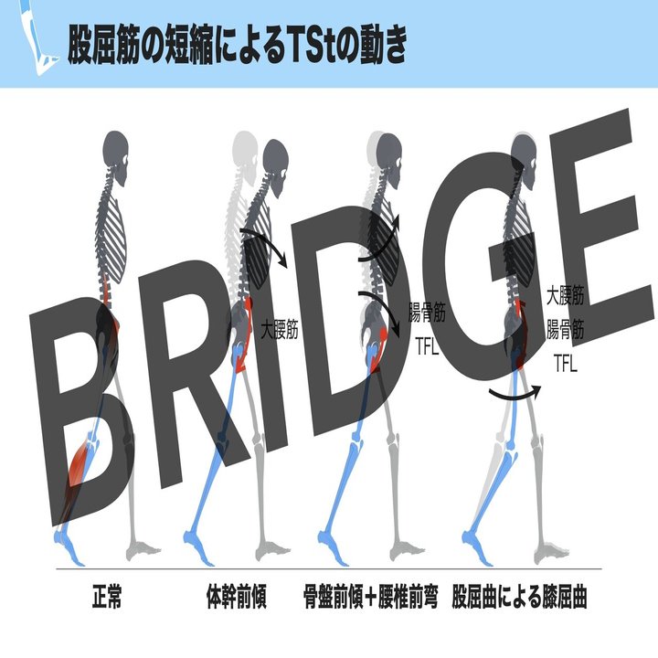 注目ショップ・ブランドのギフト ☆美品 脳卒中片麻痺患者の歩行
