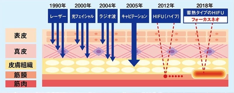 フォーカスネオ1
