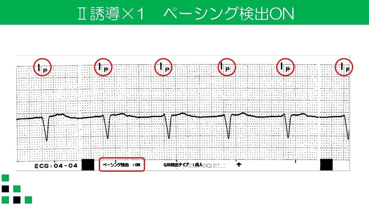 ペーシング検出　Ⅱ誘導