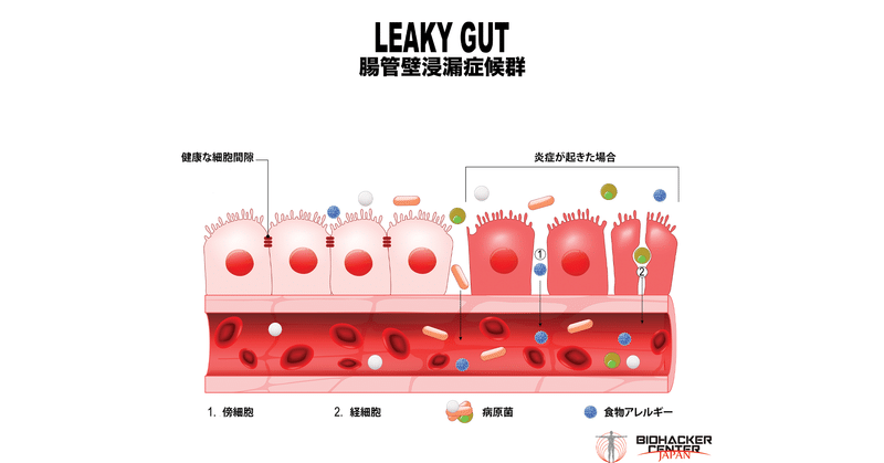 Leaky Gut Syndrome(LGS) 腸管壁浸漏症候群