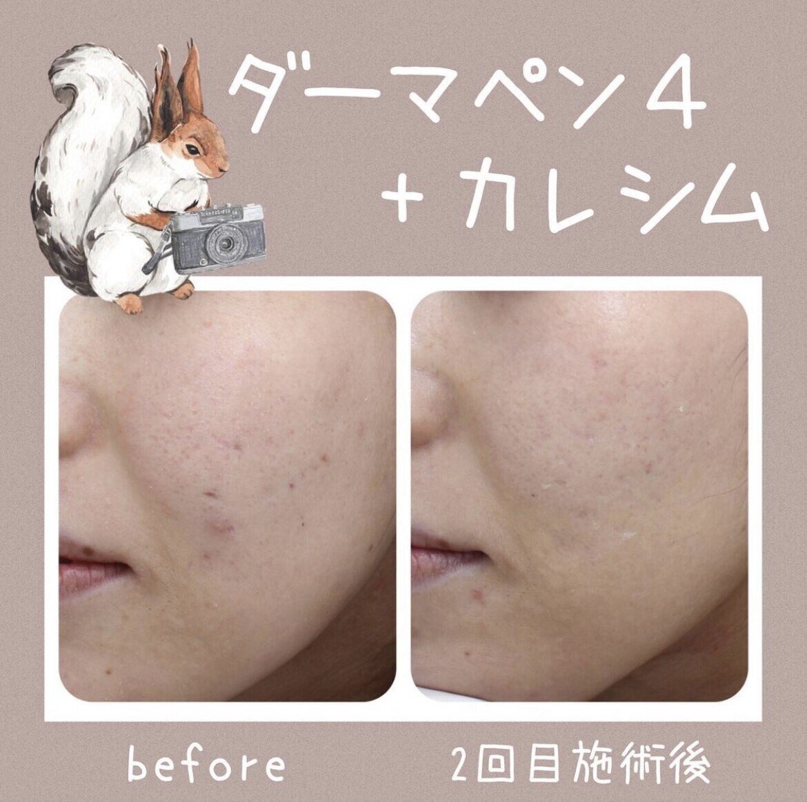 ダーマペンだけでは終わらない！｜『ともじり美容note』