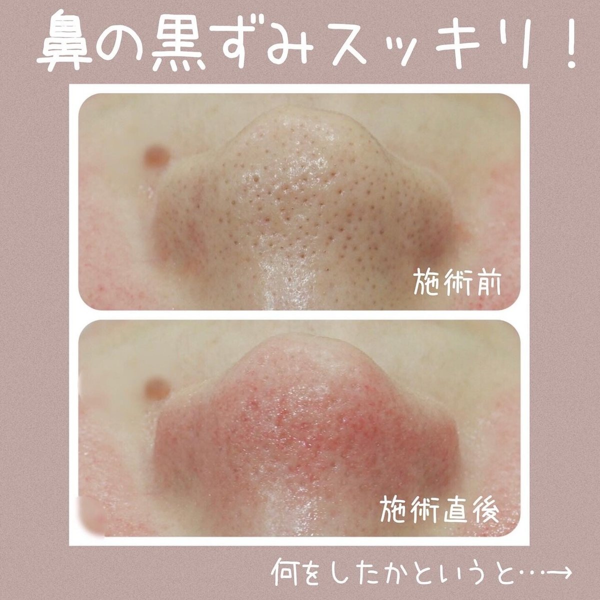 ダーマペン　CLRローション15ml×2個 ダーマペン社公認「CLRローション」は肌質改善美容液として