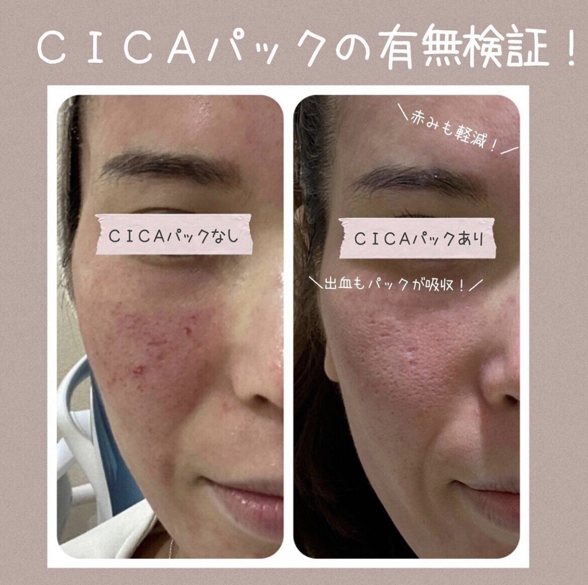 SALE】 ダーマペン CLRローション 美容液 - education.semel.ucla.edu