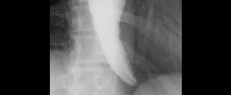 専門病院から、また別の専門病院へ。【食道アカラシアと診断されるまで （６）】