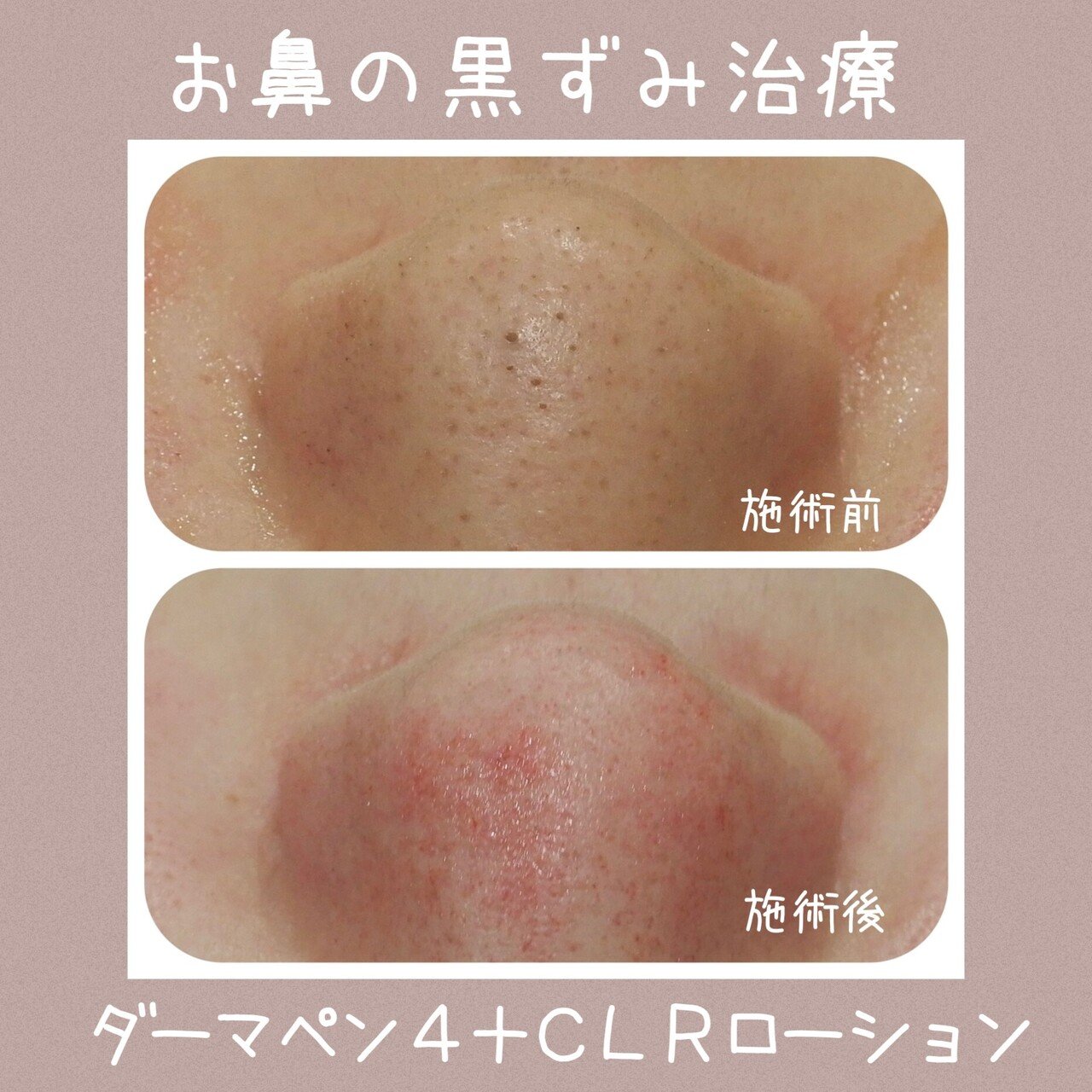 最大の割引 ダーマペン公認 DERMACEUTICALS CLRローション シャンプー