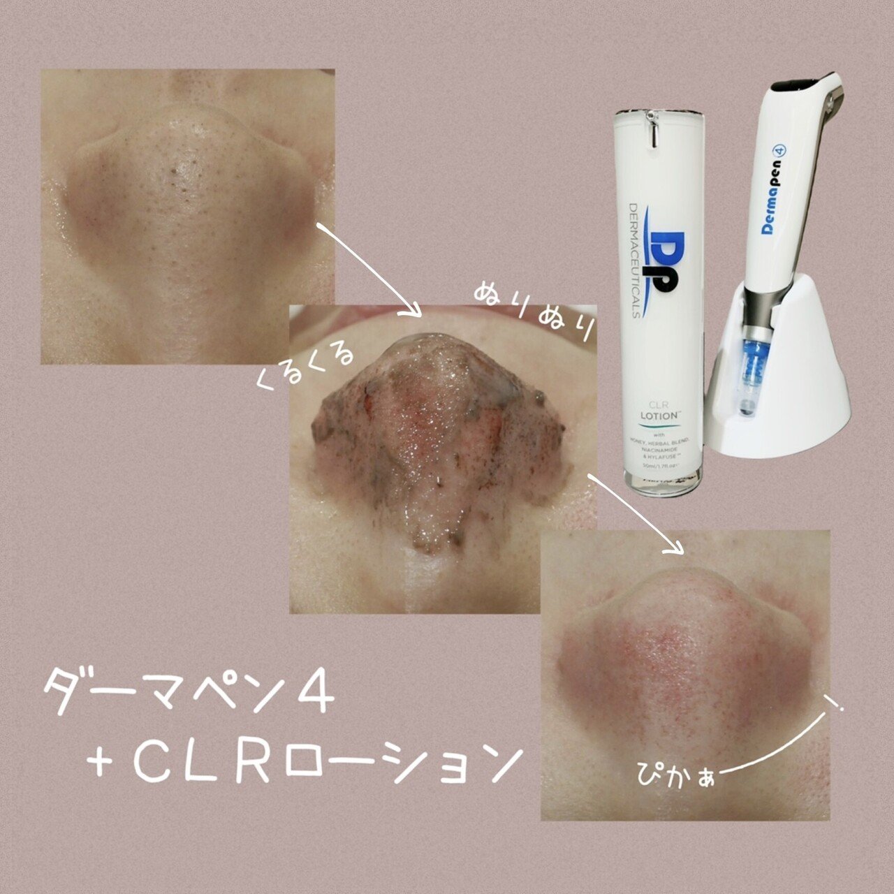 ダーマペン CLRローション 【DERMACEUTICALS】