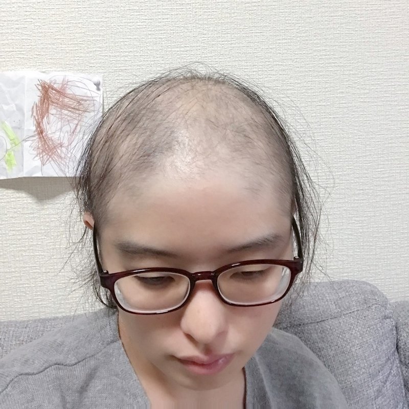 髪が抜けるということ Natsumi And Y Note 髪が抜けるということ Natsumi And Y Note