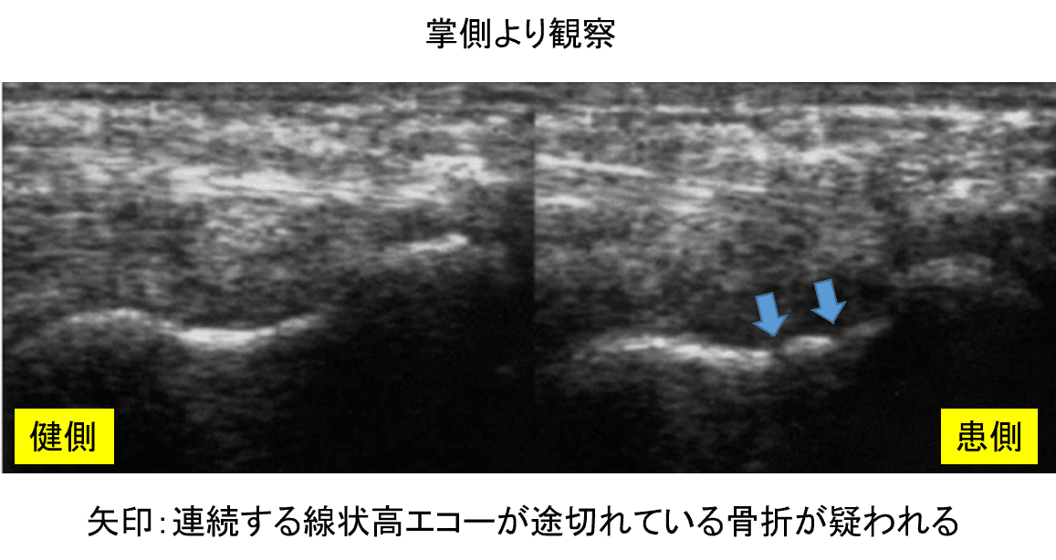 エコー掌側より観察
