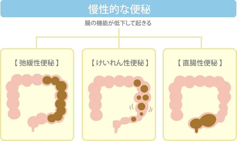 便秘 種類