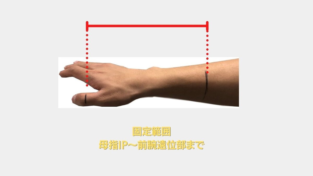 舟状骨固定サムスピカ