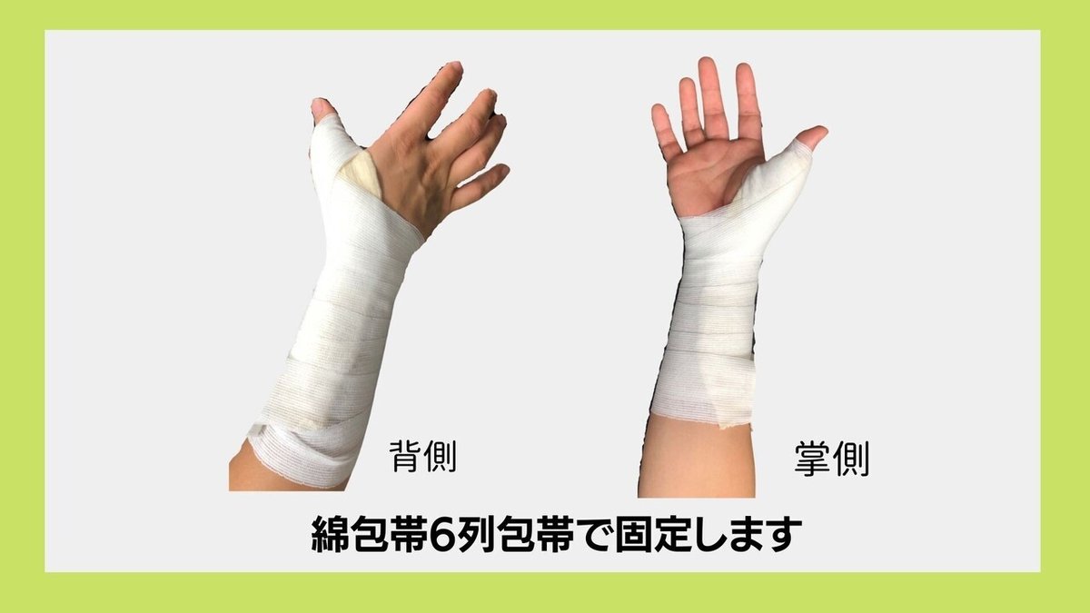 舟状骨固定サムスピカ (2)