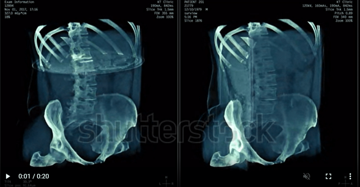 放射線検査学 X線 roentgen1.jpg