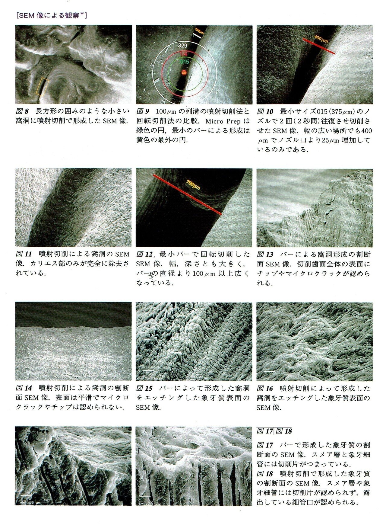 Minimal Interventionの観点から歯科のう蝕治療に欠かせないAir