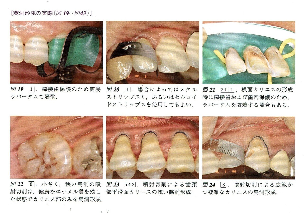 歯を守るう蝕治療　非切削う蝕治療へのパラダイムシフト 歯を守る う蝕治療 - クインテッセンス出版