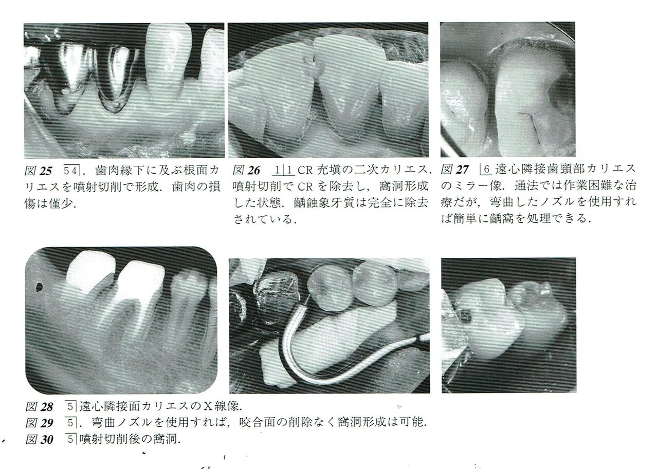 Minimal Interventionの観点から歯科のう蝕治療に欠かせないAir