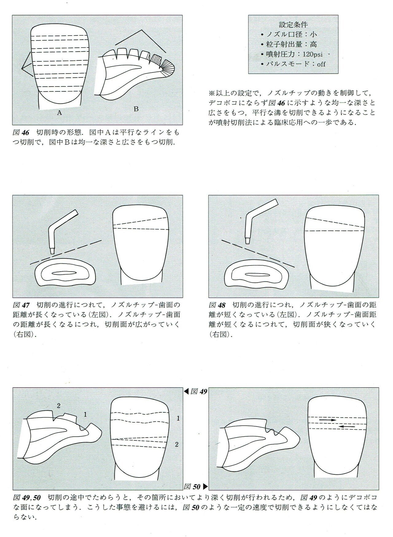 Minimal Interventionの観点から歯科のう蝕治療に欠かせないAir