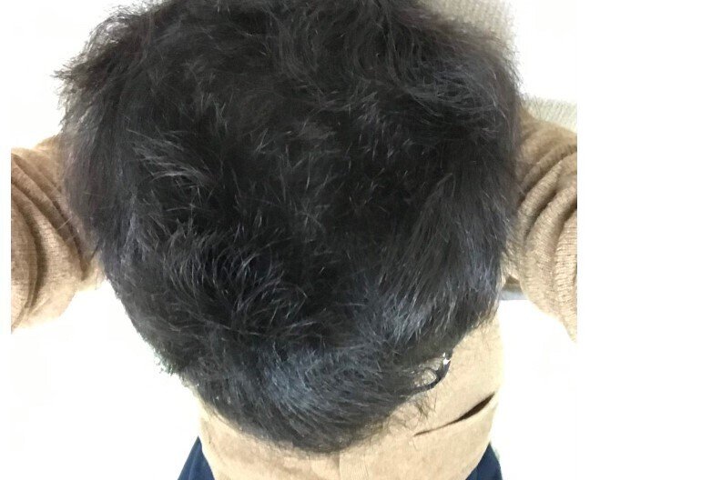 加藤発毛写真
