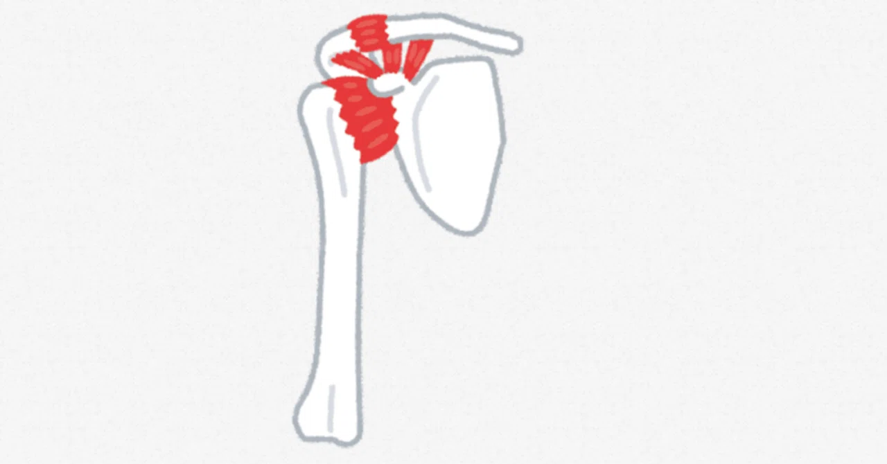 Mechanism and Treatment of Frozen Shoulder (Inflammatory Phase)｜Body ...