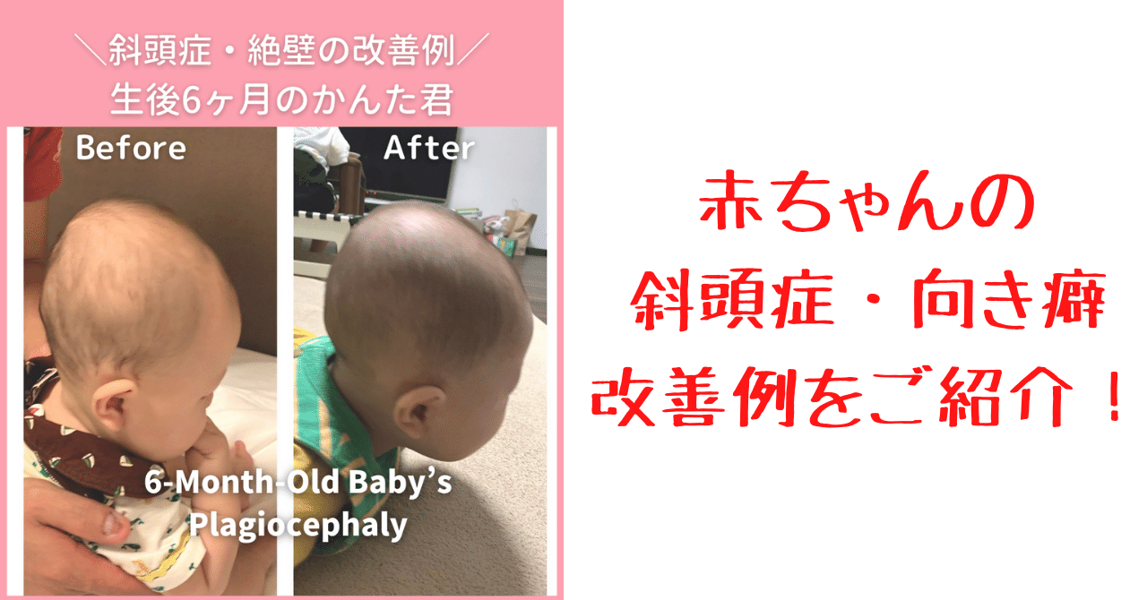 赤ちゃんの斜頭症 向き癖の改善例をご紹介 生後６ヶ月の頭の形がこうなりました 小松広明 Note
