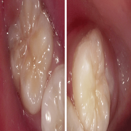 削らないむし歯。｜sho