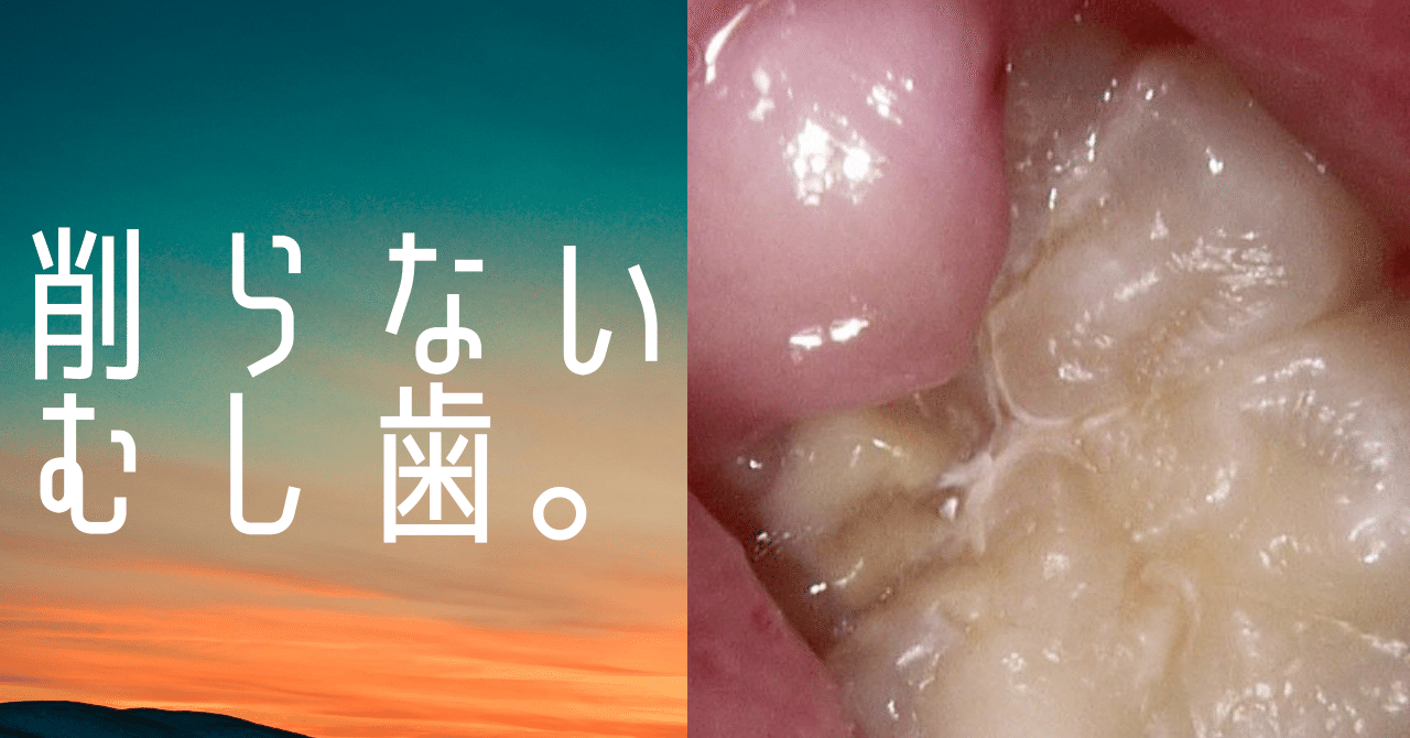 削らないむし歯。｜sho