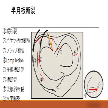 半月板損傷(基礎編)｜臼井 勇輔