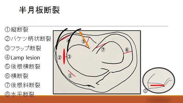 裁断 半月板のすべて 半月板のすべて−解剖から縫合手術,再生治療まで | 宗田 大
