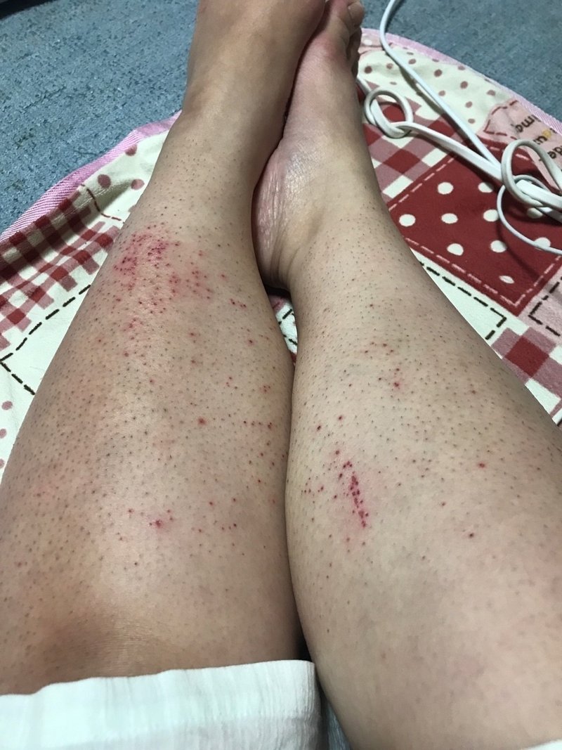 除毛クリームでムダ毛処理 体験談 松葉ガニ Note 除毛クリームでムダ毛処理 体験談 松葉ガニ Note