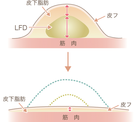 脂肪吸引