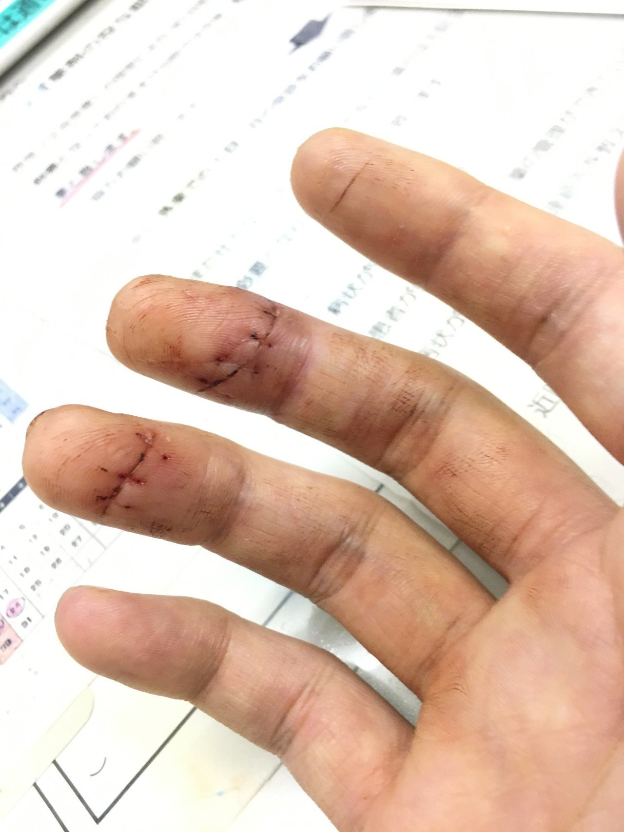 グロ注意 指を合計7針縫う怪我をしたときの治療の経過です しょ Note