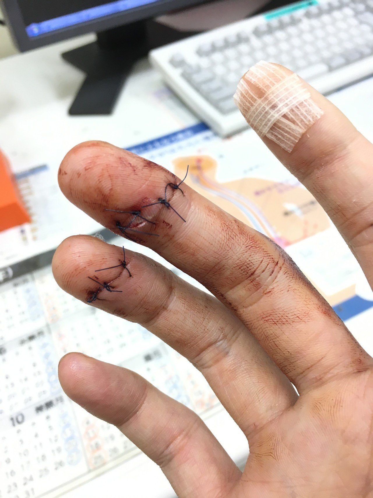 グロ注意 指を合計7針縫う怪我をしたときの治療の経過です しょ Note
