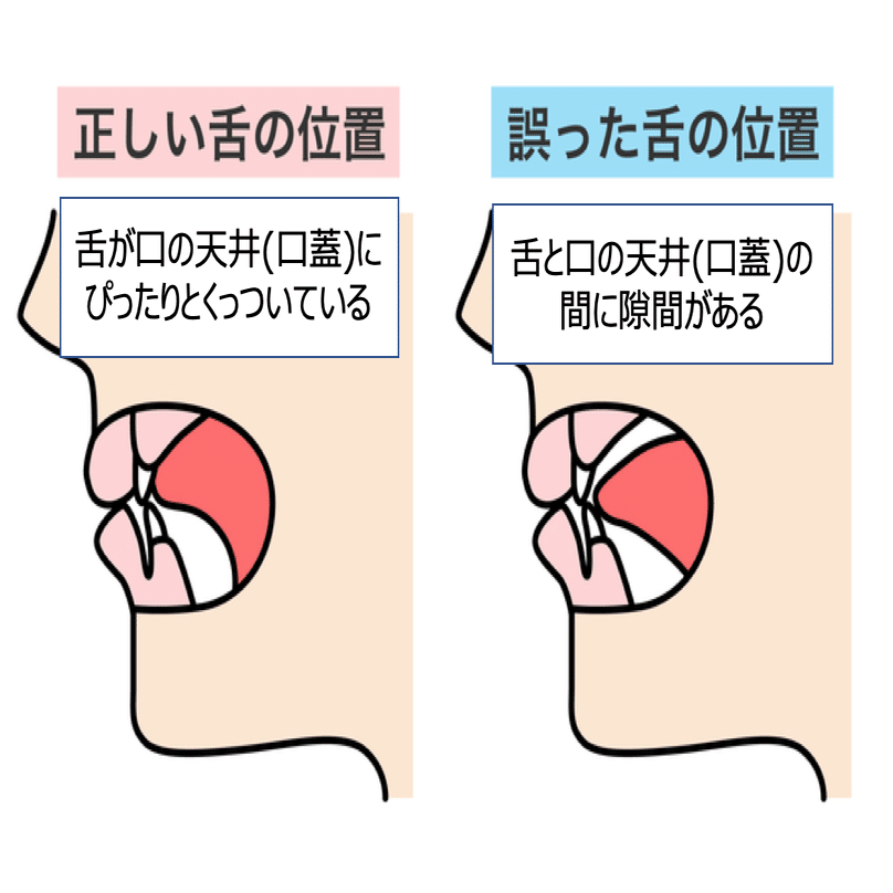 子どもの発音の誤り キ ケ が苦手なのは口腔機能発達不全症かも 言語聴覚士 木山幸子 ことばと脳の相談室 ことばのオンライン相談室 Note