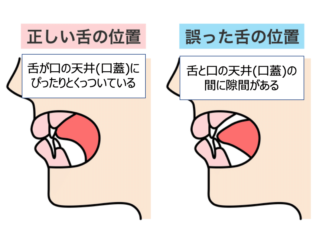 子どもの発音の誤り キ ケ が苦手なのは口腔機能発達不全症かも 言語聴覚士 木山幸子 ことばと脳の相談室 ことばのオンライン相談室 Note 子どもの発音の誤り キ ケ が苦手なのは口腔機能発達不全症かも 言語聴覚士 木山幸子 ことばと脳の相談室 ことばのオンライン相談室 Note