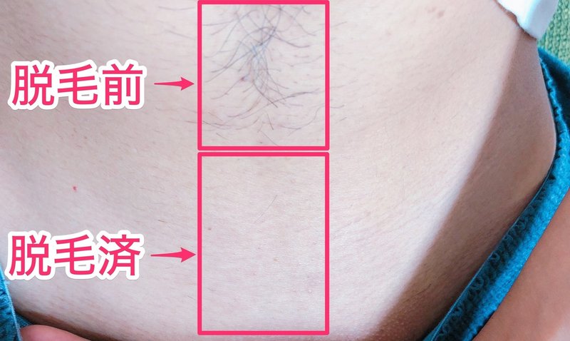 男の私がvio脱毛をしてよかった5つのこと 画像あり Ys Note